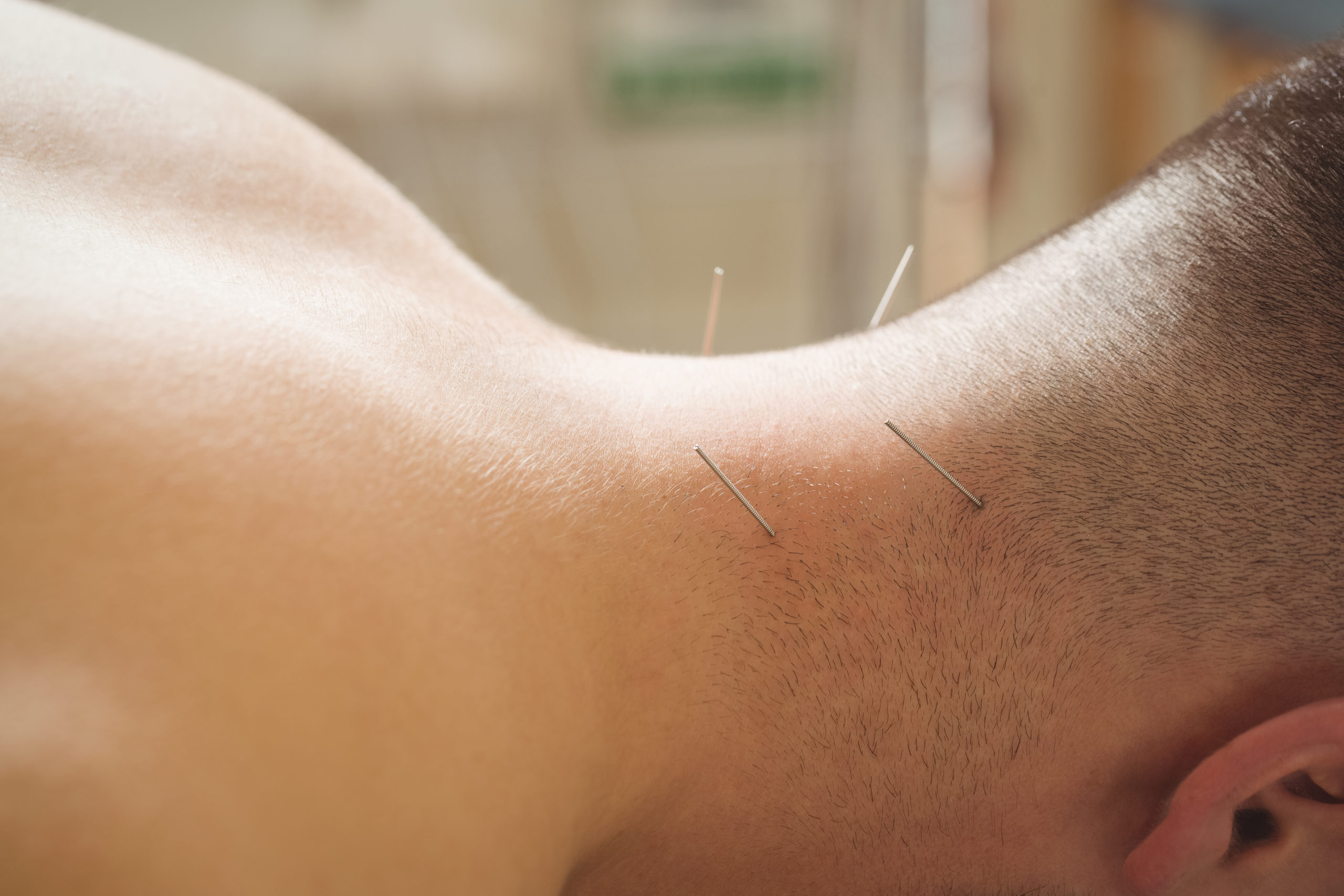 Close-up of a patient getting dry needling on neck